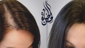 زراعة الشعر