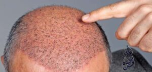 زراعة الشعر